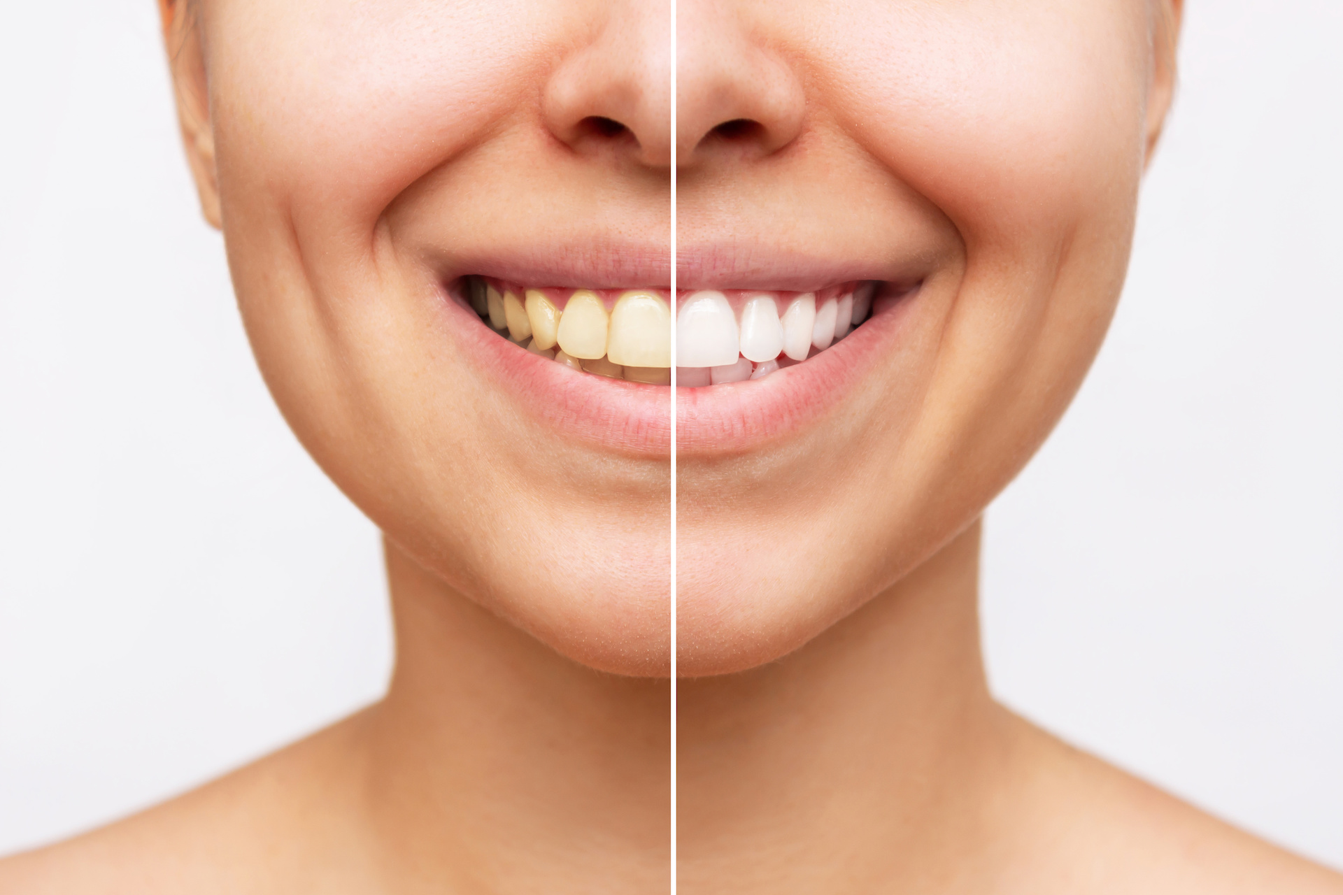 trattamento sbiancante denti | ilpuntoigieneorale.it